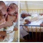 National Hospital discharges separated conjoined twins