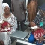 FMCs in Yenagoa, Yola successfully separate Bayelsa-born Siamese twins free of charge