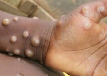 Mpox: Stigma may hamper Nigeria’s response efforts, says expert