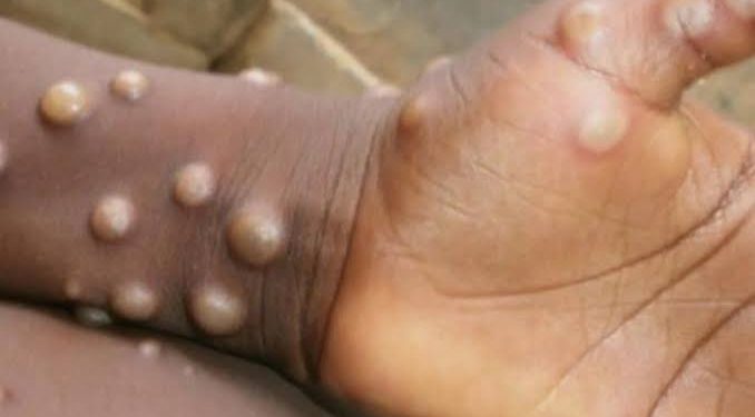Mpox: Stigma may hamper Nigeria’s response efforts, says expert