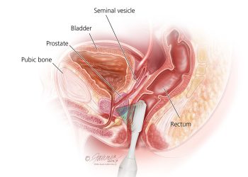 Constant sexual intercourse does not prevent prostate cancer– urologist