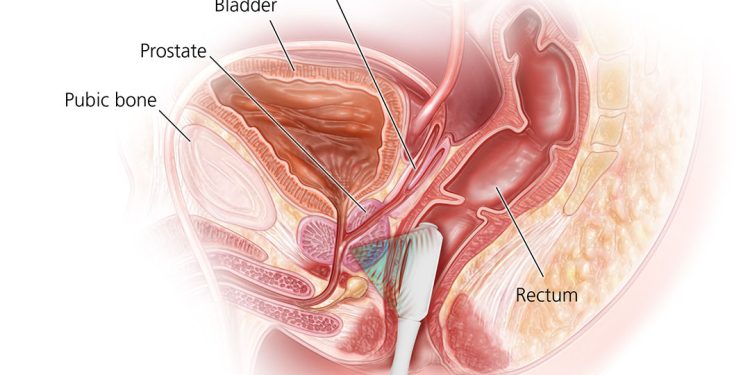 Urological Illustrations by Fairman Studios for American Urological Association patient education materials