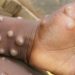 Sierra Leone’s Mpox surge raises alarm across Africa- CDC