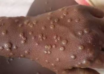 Africa CDC raises alarm over rising Mpox cases, as Namibia records first outbreak